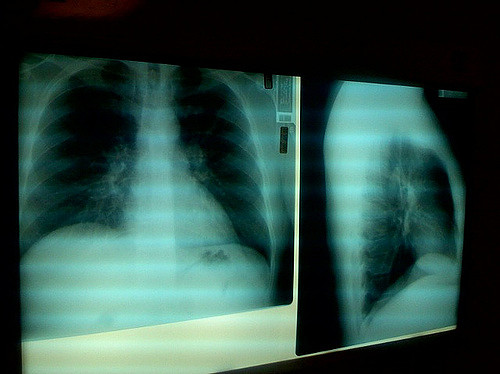 radio pulmonaire de Pierre