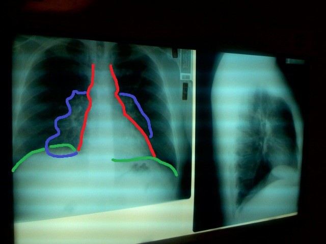 radio pulmonaire annotée de Pierre