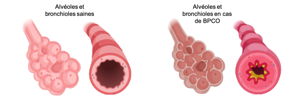 Schéma explicatif de la BPCO
