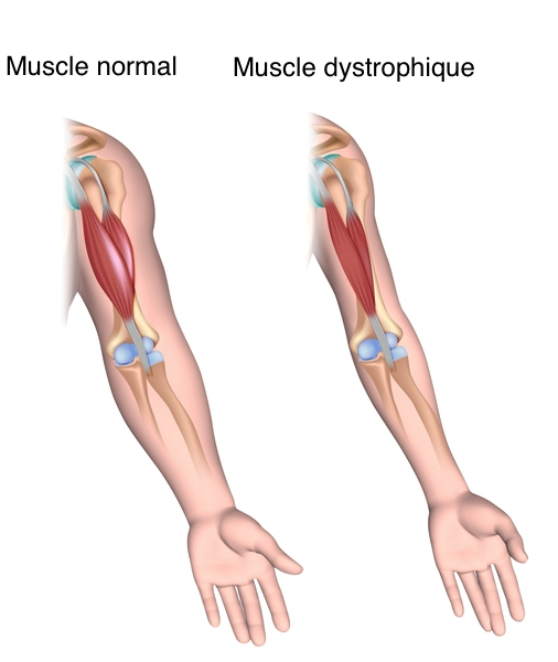 Les myopathies trop fortes pour nous ?